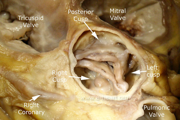 Rheumatic Ao V Old